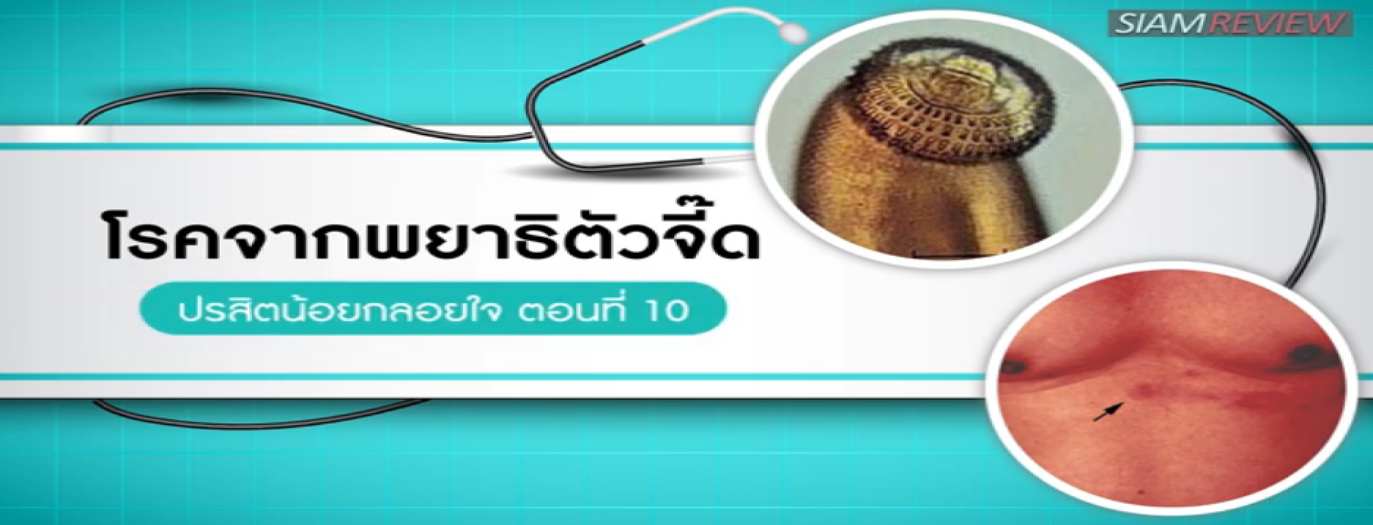 รูปประกอบ ปรสิตน้อยกลอยใจ ตอนที่ 10: โรคจากพยาธิตัวจี๊ด