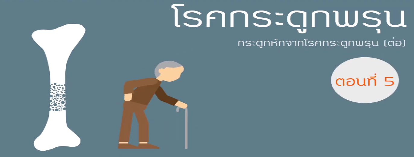 รูปประกอบ พบอาจารย์หมอกระดูกธรรมศาสตร์ ตอนที่ 5: กระดูกหักจากโรคกระดูกพรุน (ต่อ)