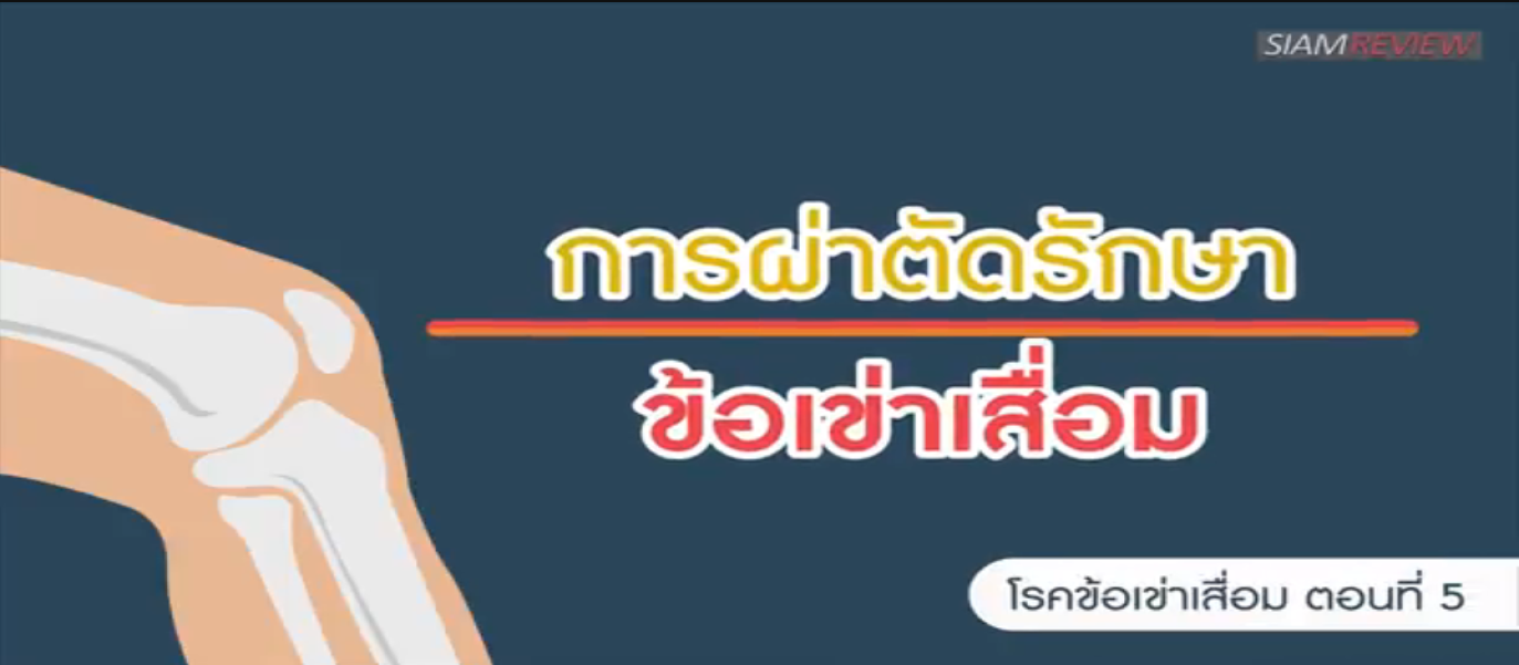 รูปประกอบ พบอาจารย์หมอกระดูกธรรมศาสตร์: ตอนที่ 5 เข่าเสื่อมทั้งสองข้าง ผ่าทีละข้าง หรือสองข้างดี?